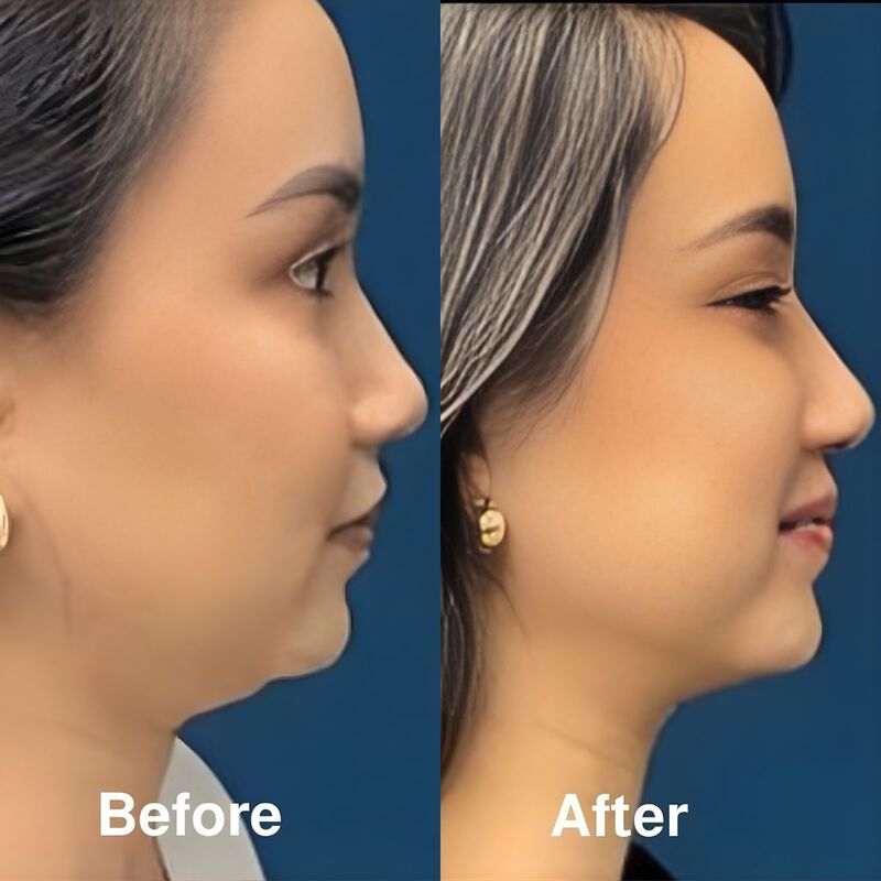 jovs vlift antiageing device