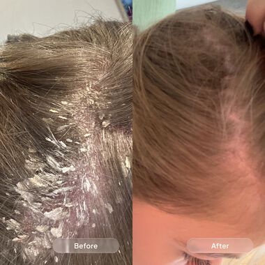 faces dandruff   soothing routine